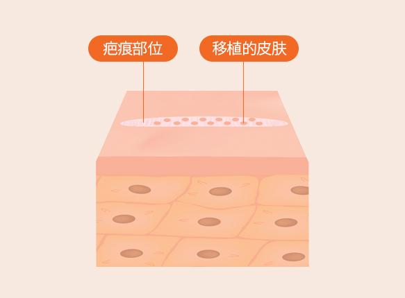 SST피부이식술