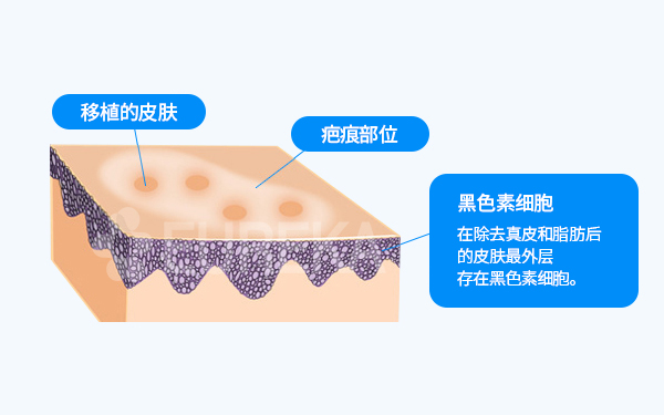 백반증 치료 SST 피부이식술