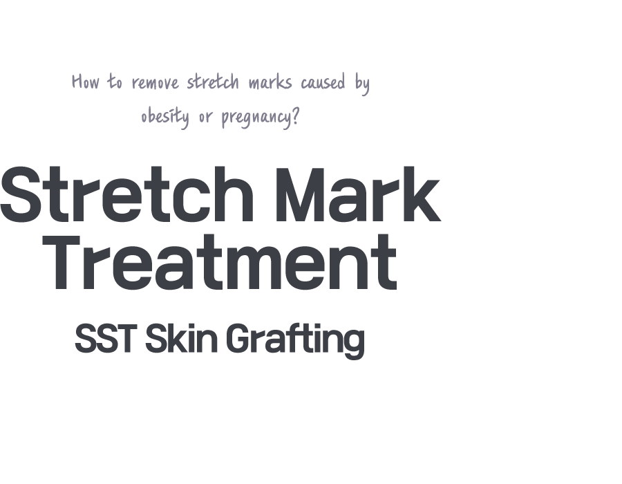 튼살치료 SST피부이식술