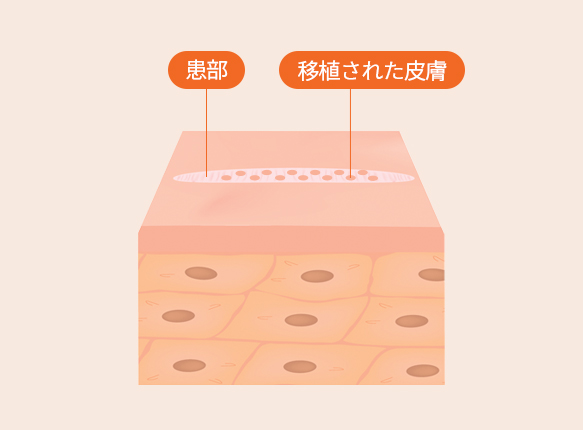 SST피부이식술