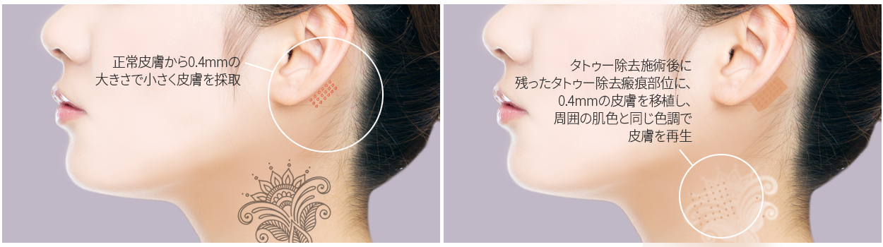 SST전층피부이식술 흉터치료