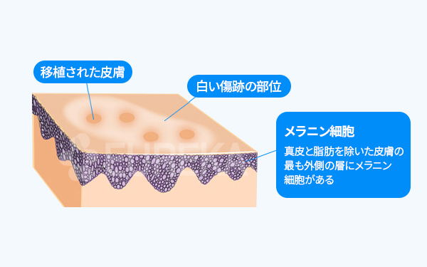 백반증 치료 SST 피부이식술