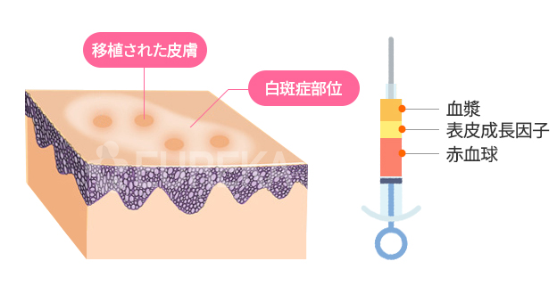 피부이식술이란?