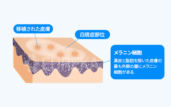 백반증 치료 SST 피부이식술